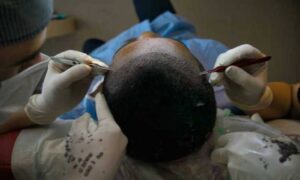 Clínica de transplante capilar é condenada a indenizar 750x450.jpg